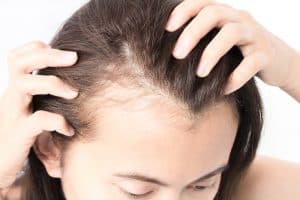 Postpartum Hair Loss