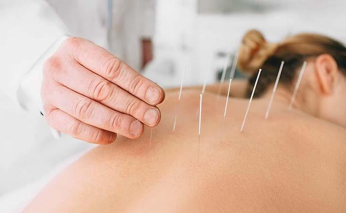 accupuncture advice