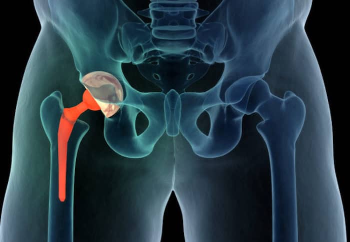 Signs That Indicate You Need A Hip Joint Replacement Surgery