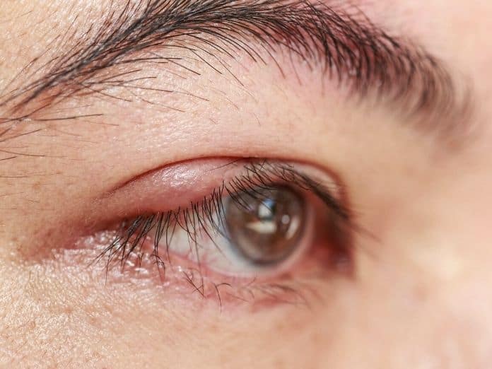 The Most Common Infections of the Eye