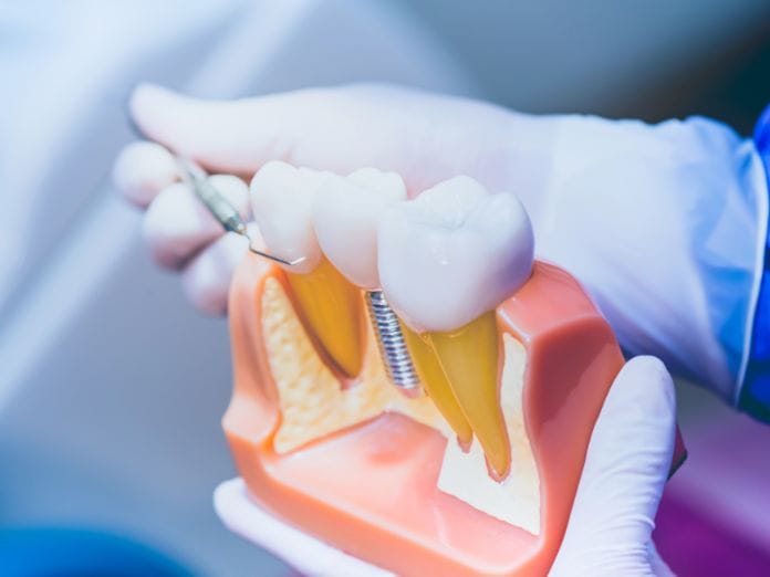 Top Dental Implant Care Tips You Should Follow