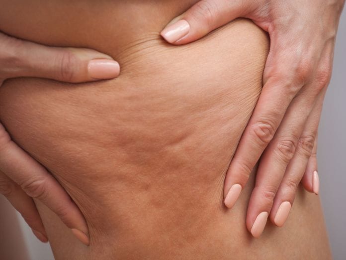 Cellulite: What Is It and How To Get Rid of It