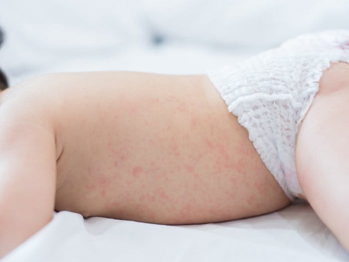 A baby laying on their belly in a diaper. They are displaying a heat rash on their abdomen and backside.