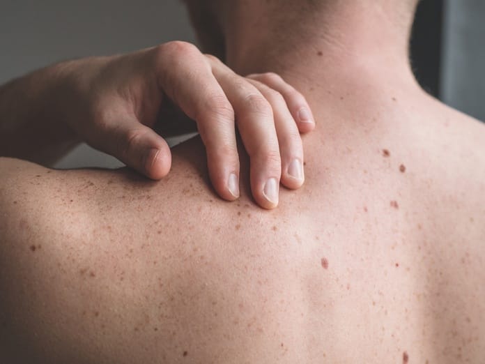 A close-up of a man's back, which has several moles and freckles. His left hand reaches to touch his shoulder.