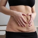 A person pressing their hands around the loose skin above the recently formed C-section scar on their lower abdomen.