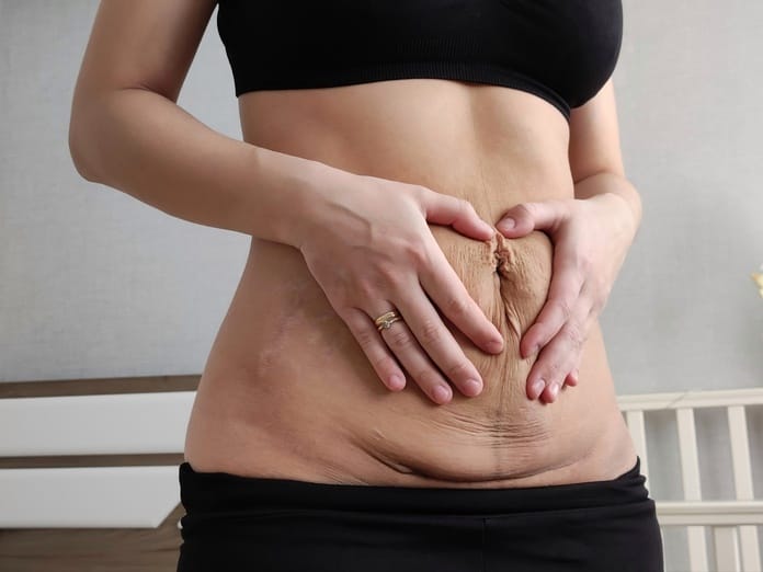 A person pressing their hands around the loose skin above the recently formed C-section scar on their lower abdomen.